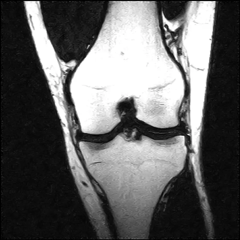 A slice of a knee MRI with the joint outlined in yellow.